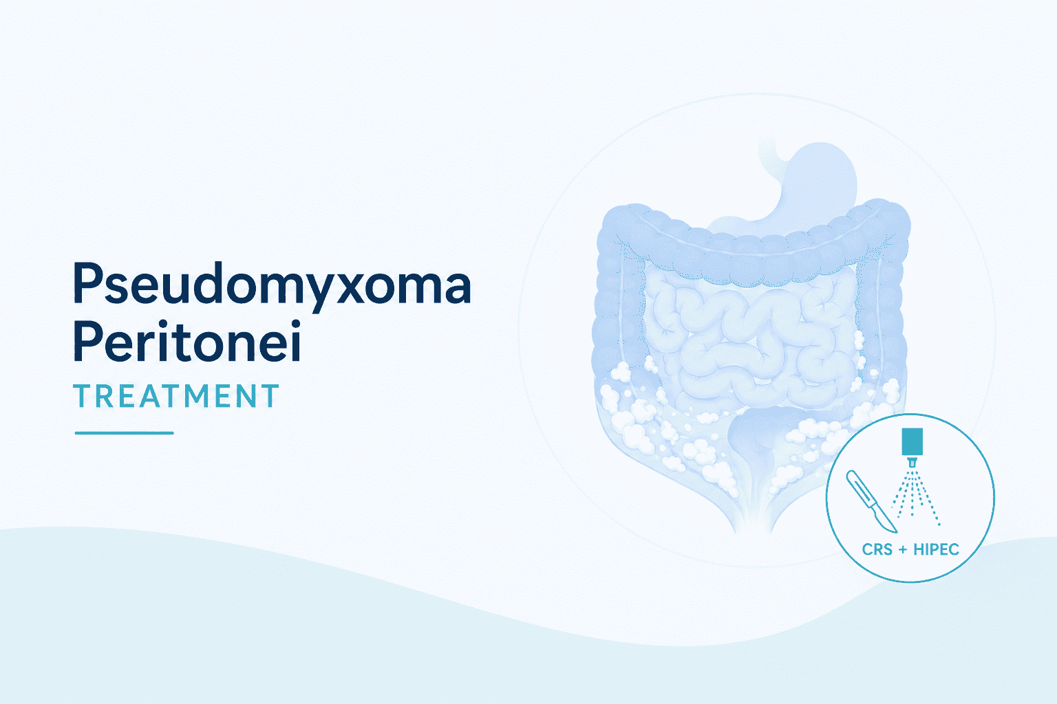 Best Pseudomyxoma Peritonei Treatment in Mulund