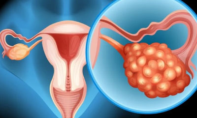 Cytoreductive Surgery (CRS) & HIPEC