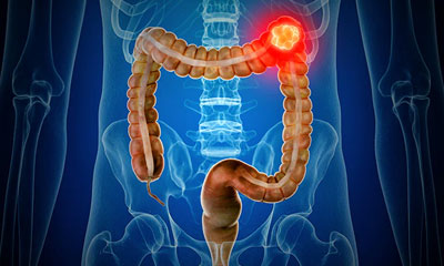 Recurrent Colorectal Cancer Treatment